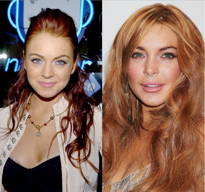 Lindsay Lohan est du genre à commettre des abus en tout genre... Y compris lorsqu'il s'agit de chirurgie esthétique. Lèvres, pommettes, what's next ?
