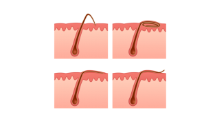 Poil incarné : Comment se débarrasser de ce problème gênant (Causes et ...