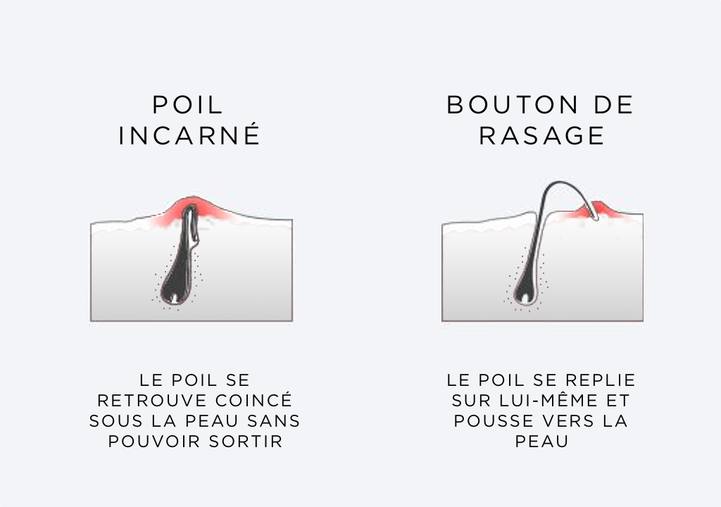 Poil incarné : Comment se débarrasser de ce problème gênant (Causes et ...