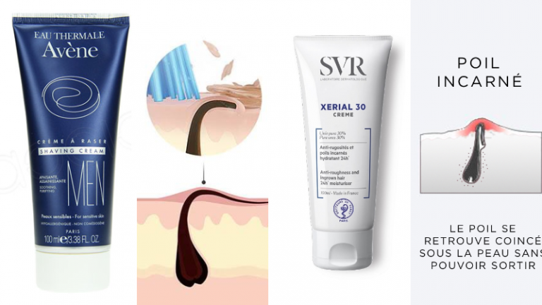 Poil incarné : Comment se débarrasser de ce problème gênant (Causes et ...