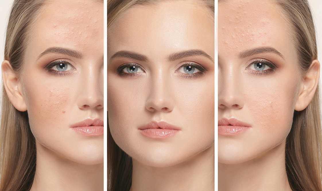 Peeling visage Tout ce qu
