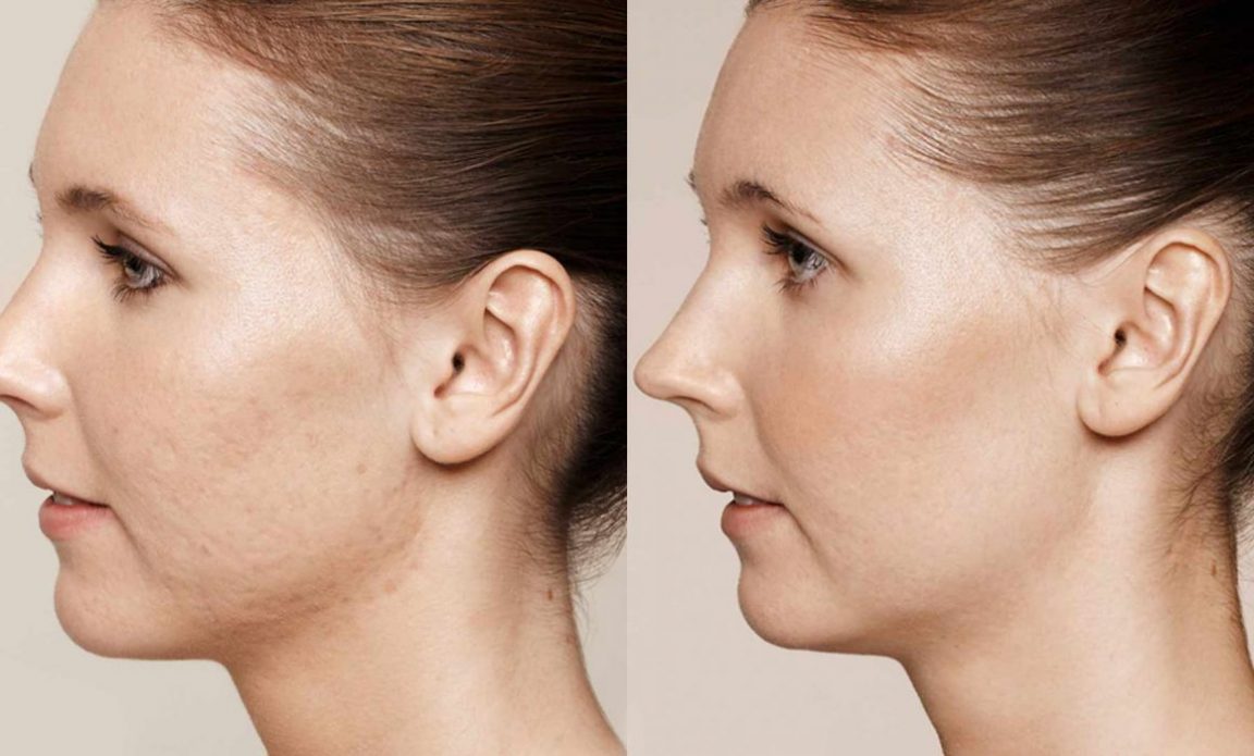 Peeling Visage Tout Ce Qu Il Faut Savoir Sur Le Prix Types Et Techniques Du Peeling