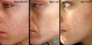 Peeling Visage : Tout Ce Qu'il Faut Savoir Sur Le Prix, Types Et ...