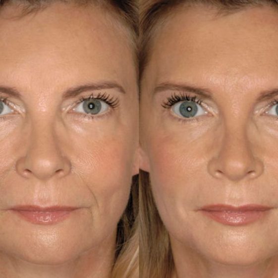 Peeling Visage Tout Ce Qu Il Faut Savoir Sur Le Prix Types Et Techniques Du Peeling