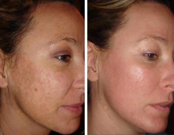 Peeling Visage Tout Ce Qu Il Faut Savoir Sur Le Prix Types Et Techniques Du Peeling