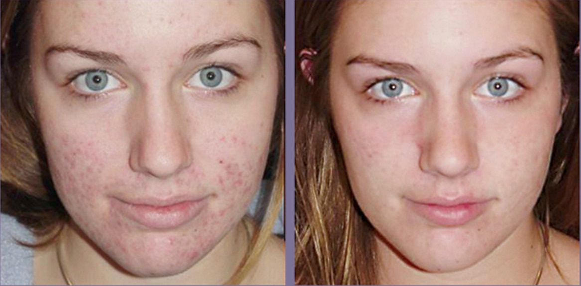 Peeling Visage : Tout Ce Qu'il Faut Savoir Sur Le Prix, Types Et ...